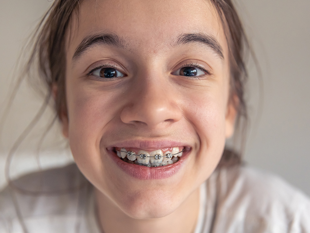 Coloured / Clear Braces