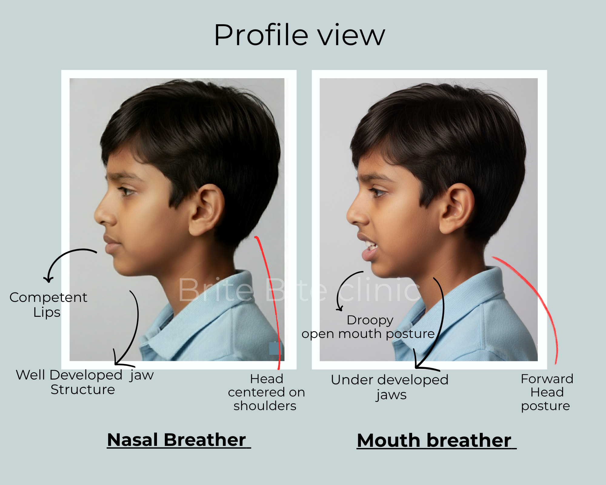 Facial profile comparison of a child who is a mouth breather versus a nasal breather. 
The nasal breather shows competent lips, well-developed jaw structure, and head centered on 
shoulders, while the mouth breather has a droopy open-mouth posture, underdeveloped jaws, 
and forward head posture. Brite Bite Clinic branding included.