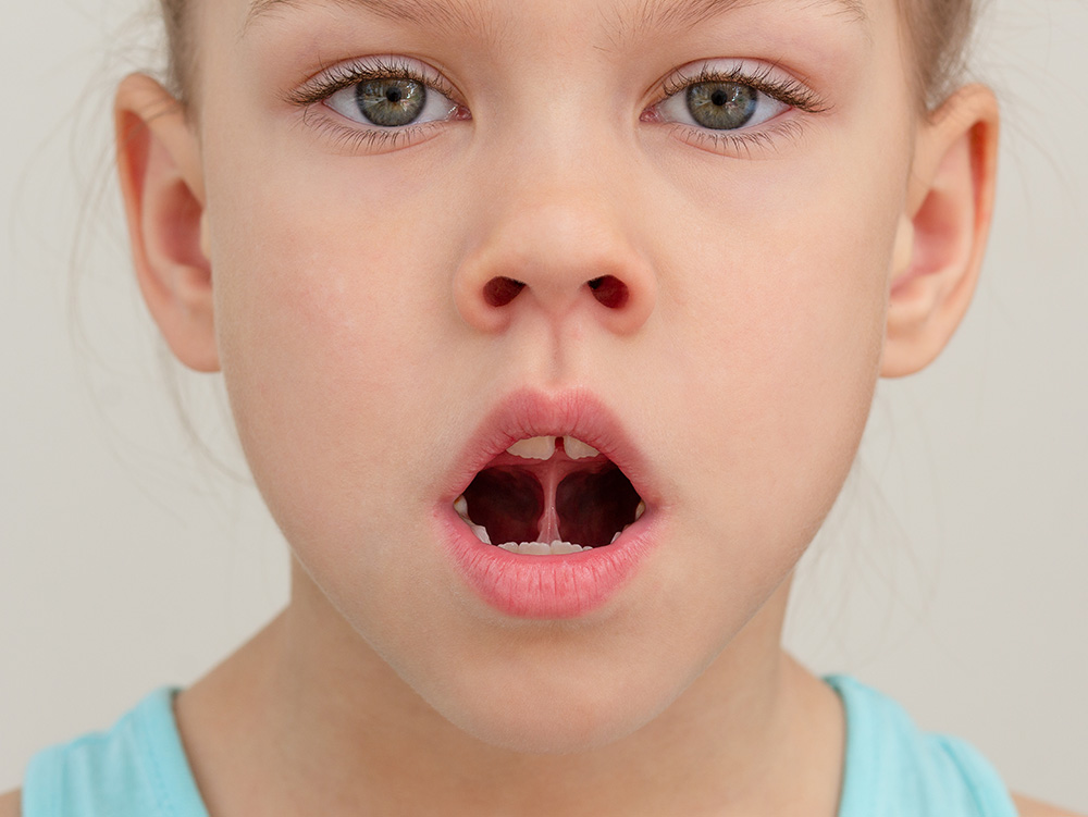 Myofunctional Therapy