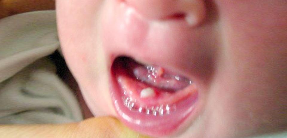 Assessment of natal teeth in a newborn
